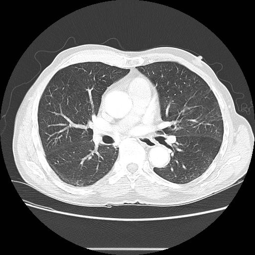 File:Bronchocele (Radiopaedia 17097-16795 Axial lung window 61).jpg