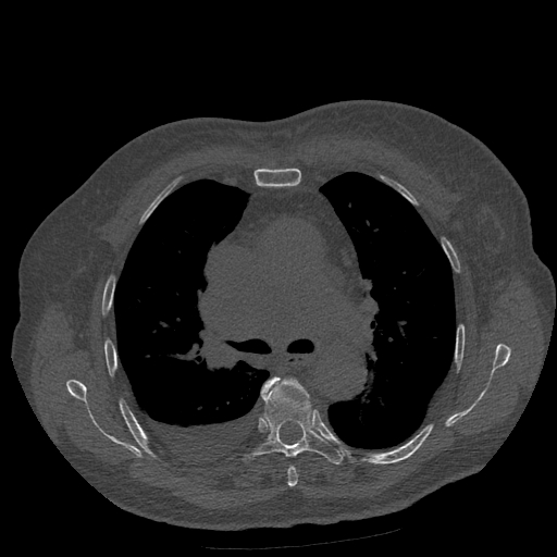 Bronchogenic carcinoma with metastatic lymphadenopathy (Radiopaedia 37671-39569 Axial bone window 23).jpg