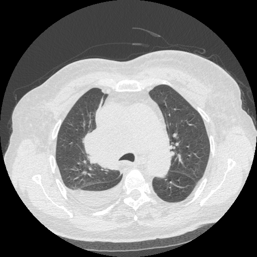 Bronchogenic carcinoma with metastatic lymphadenopathy (Radiopaedia 37671-39569 Axial lung window 19).jpg