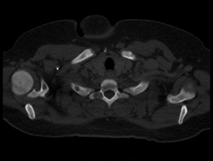 Brown tumors compressing the spinal cord (Radiopaedia 68442-77988 Axial bone window 5).jpg