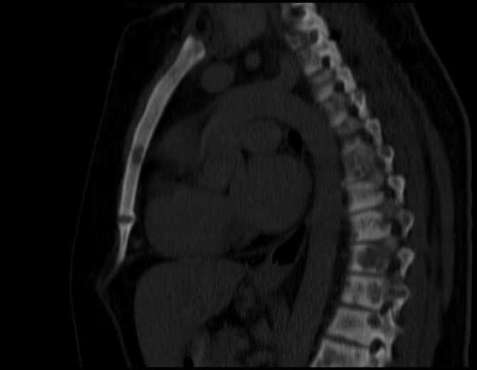 Brown tumors compressing the spinal cord (Radiopaedia 68442-77988 Sagittal bone window 32).jpg