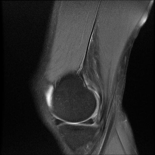 File:Bucket-handle meniscus tear (Radiopaedia 65700-74809 Sagittal PD fat sat 6).jpg