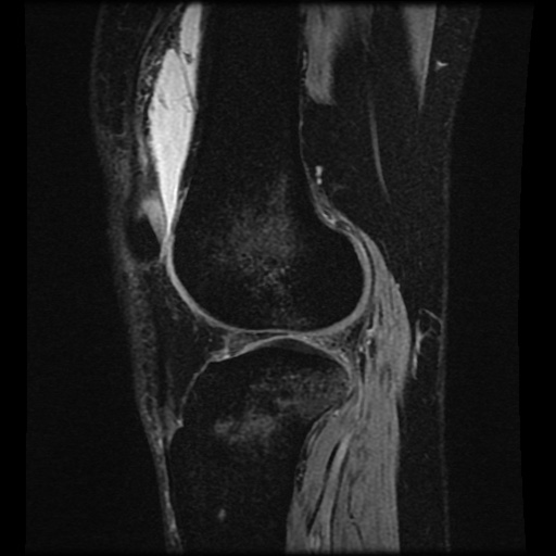 Bucket handle meniscus tear (Radiopaedia 56916-63751 H 25).jpg