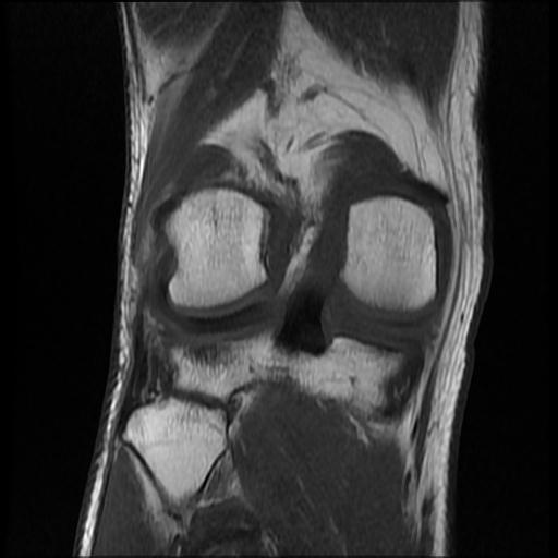 File:Bucket handle tear - medial meniscus (Radiopaedia 69245-79026 Coronal T1 15).jpg