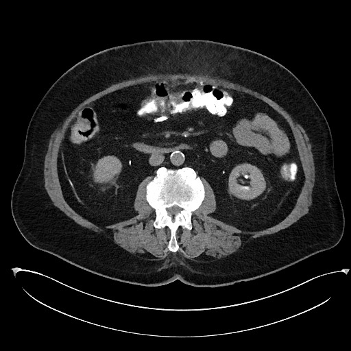 Buried bumper syndrome - gastrostomy tube (Radiopaedia 63843-72577 Axial Inject 53).jpg