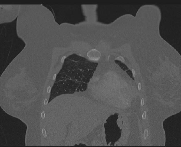 Burst fracture - thoracic spine (Radiopaedia 30238-30865 Coronal bone window 38).jpg
