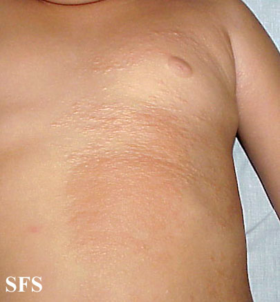 Buschke-Ollendorf Syndrome (Dermatology Atlas 3).jpg