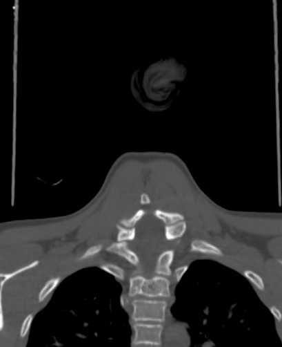Butterfly vertebra (Radiopaedia 77903-90209 Coronal bone window 66).jpg