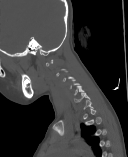 Butterfly vertebra (Radiopaedia 77903-90209 Sagittal bone window 99).jpg