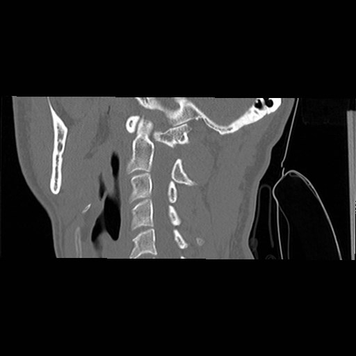File:C1-C2 "subluxation" - normal cervical anatomy at maximum head rotation (Radiopaedia 42483-45607 C 39).jpg