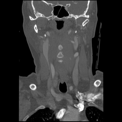 C1 anterior arch (plough) fracture - type 1 (Radiopaedia 76181-87720 Coronal bone window 67).jpg