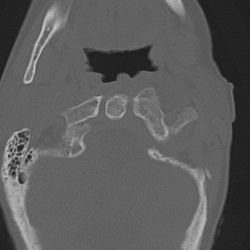 File:C2 fracture with vertebral artery dissection (Radiopaedia 37378-39199 Axial bone window 12).png
