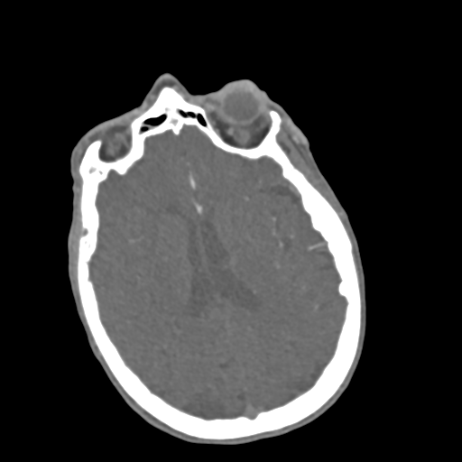 C2 fracture with vertebral artery dissection (Radiopaedia 37378-39200 A 258).png