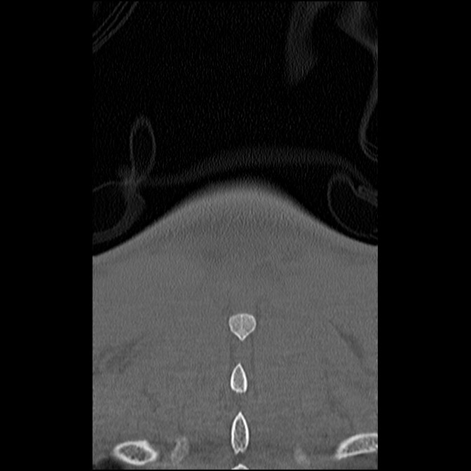 C5 facet fracture (Radiopaedia 58374-65499 Coronal bone window 60).jpg