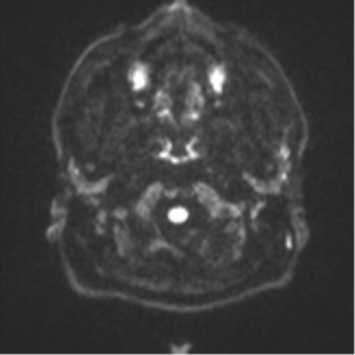 File:CNS vasculitis (Radiopaedia 55715-62263 Axial DWI 30).png
