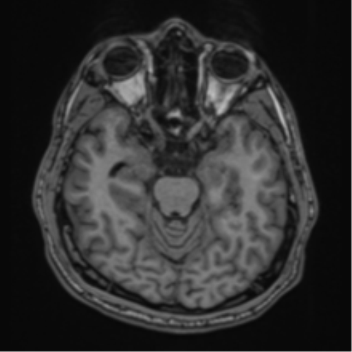 CNS vasculitis (Radiopaedia 55715-62263 Axial T1 5).png