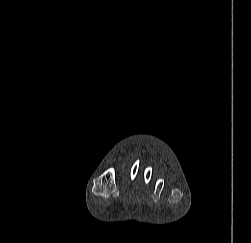 Calcaneal fracture - Sanders type 4 (Radiopaedia 90179-107370 Coronal bone window 28).jpg