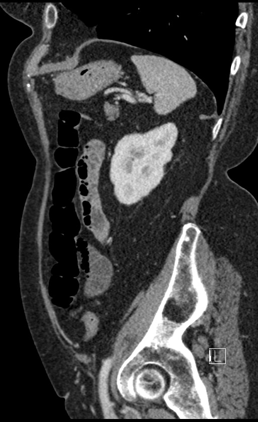 Calcified adrenal glands and Spigelian hernia (Radiopaedia 49741-54988 C 39).jpg