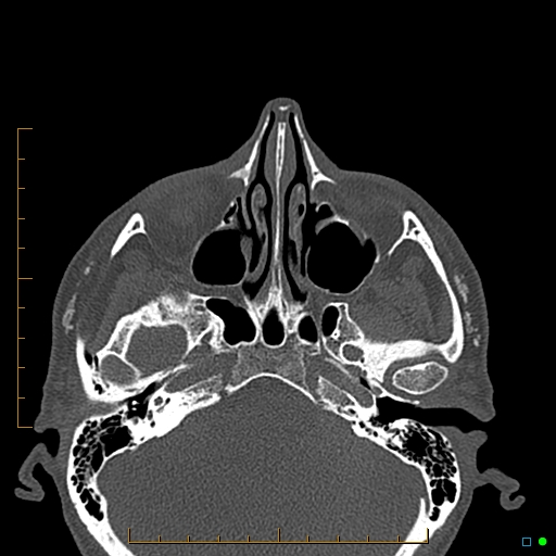 Calcified facial augmentation fillers (Radiopaedia 79514-92679 Axial bone window 7).jpg