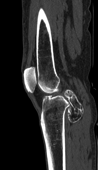 Calcified hematoma - popliteal fossa (Radiopaedia 63938-72763 Sagittal bone window 49).jpg
