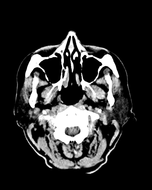 Calcified meningioma (Radiopaedia 74361-85243 Axial non-contrast 54).jpg
