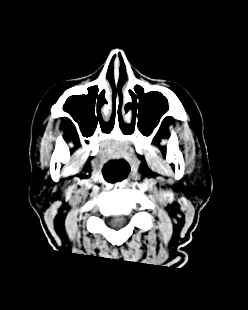 Calcified meningioma (Radiopaedia 74361-85243 Axial non-contrast 58).jpg