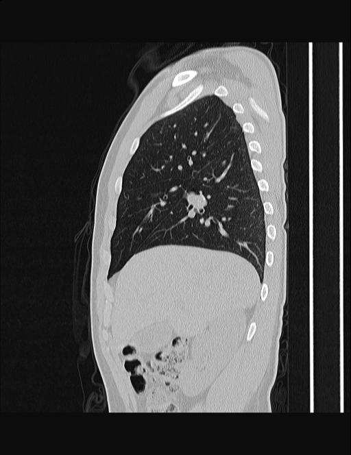 Calcifying pulmonary metastases (Radiopaedia 33359-34396 Sagittal lung window 51).jpg