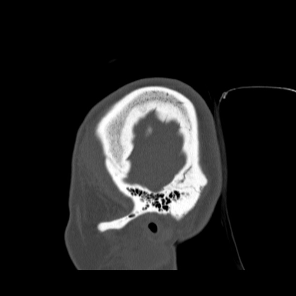 Calvarial osteoma (Radiopaedia 36520-38079 Sagittal bone window 12).jpg