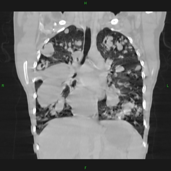 File:Cannon ball metastases - synovial sarcoma (Radiopaedia 26135-26271 Coronal lung window 9).jpg