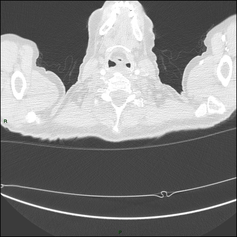 Cannonball metastases (Radiopaedia 82110-96150 Axial lung window 1).jpg