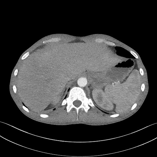 Cannonball metastases - testicular choriocarcinoma (Radiopaedia 84510-99891 B 99).jpg