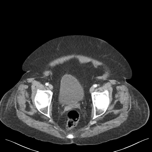 Cannonball metastases from endometrial cancer (Radiopaedia 42003-45031 E 69).png