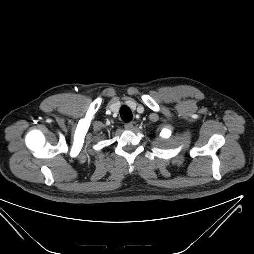 File:Cannonball pulmonary metastases (Radiopaedia 67684-77101 D 17).jpg