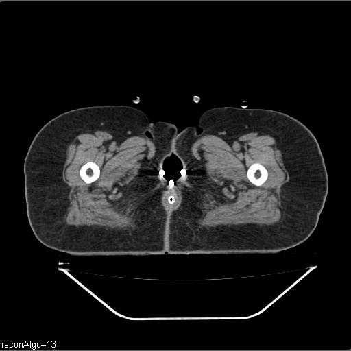 Carcinoma cervix- brachytherapy applicator (Radiopaedia 33135-34173 Axial non-contrast 58).jpg