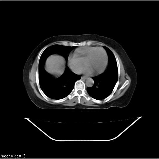 File:Carcinoma cervix- recurrence (Radiopaedia 34702-36137 Axial non-contrast 3).jpg