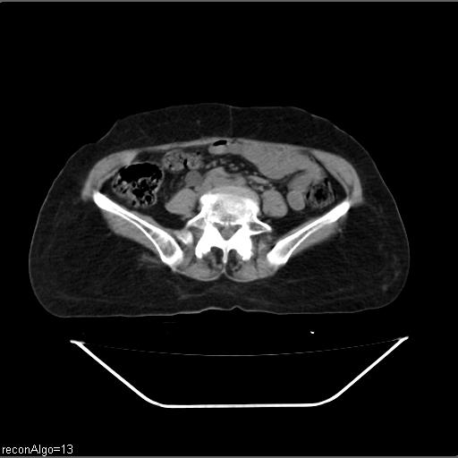 File:Carcinoma cervix- recurrence (Radiopaedia 34702-36137 Axial non-contrast 34).jpg