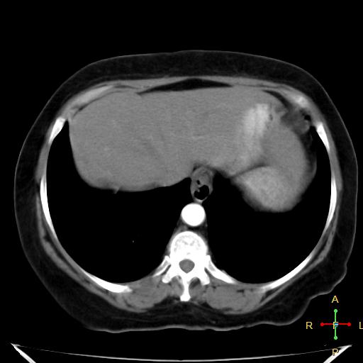 File:Carcinoma of sigmoid colon (Radiopaedia 23071-23100 C+ arterial phase 2).jpg