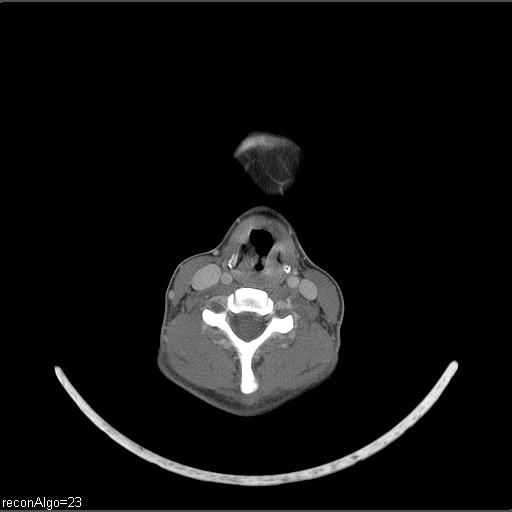 File:Carcinoma of the maxillary antrum (Radiopaedia 53805-59888 Axial C+ delayed 19).jpg
