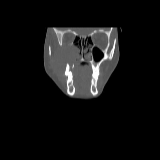 Carcinoma of the maxillary antrum (Radiopaedia 53805-59888 Coronal bone window 38).jpg