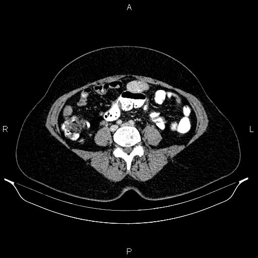 File:Carcinoma of uterine cervix (Radiopaedia 85861-101700 A 56).jpg