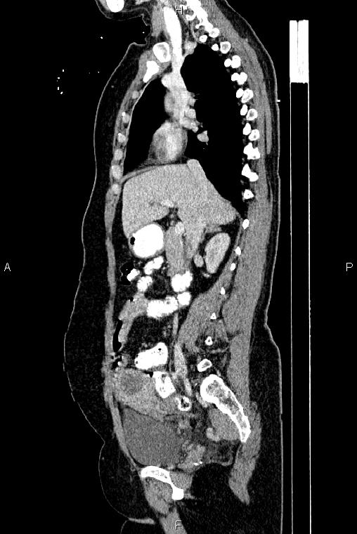 Carcinoma of uterine cervix (Radiopaedia 85861-101700 D 32).jpg