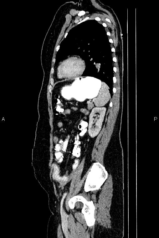 Carcinoma of uterine cervix (Radiopaedia 85861-101700 D 62).jpg