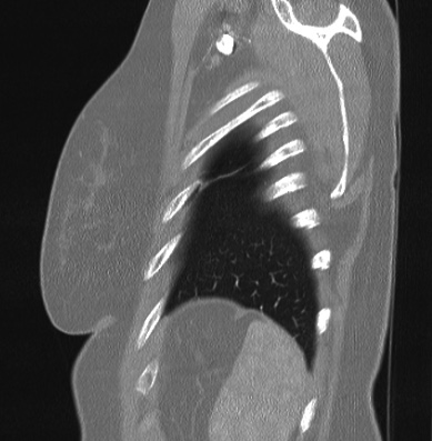 Cardiac sarcoidosis (Radiopaedia 74548-85534 Sagittal lung window 8).jpg