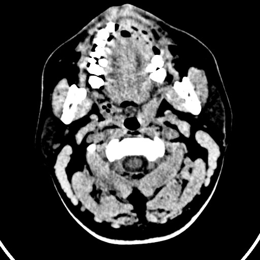 Cardioembolic stroke- ACA and MCA territories (Radiopaedia 58904-66140 Axial non-contrast 10).jpg