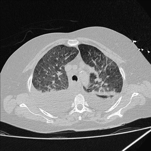 Cardiogenic pulmonary edema (Radiopaedia 29213-29609 Axial lung window 24).jpg