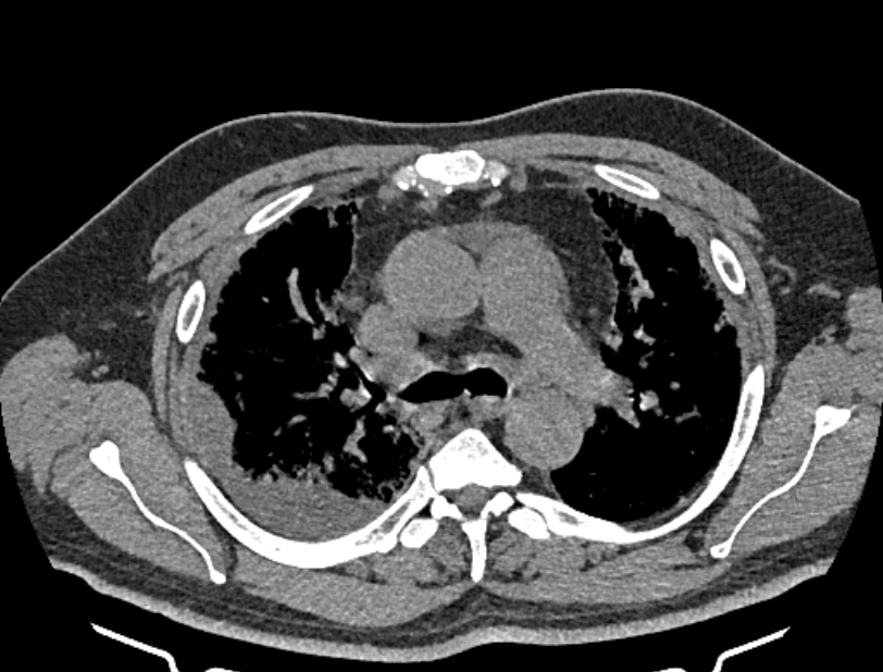 Cardiogenic pulmonary edema (Radiopaedia 68180-77678 Axial non-contrast 16).jpg