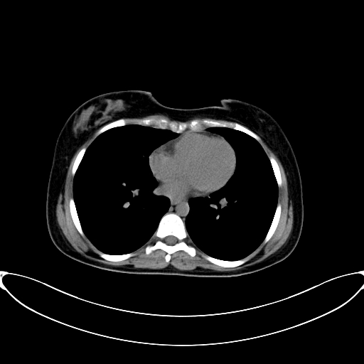 Caroli disease with medullary sponge kidney (Radiopaedia 82622-96804 Axial non-contrast 2).jpg