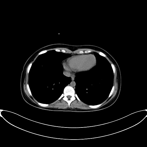 File:Caroli disease with medullary sponge kidney (Radiopaedia 82622-96804 Axial non-contrast 8).jpg
