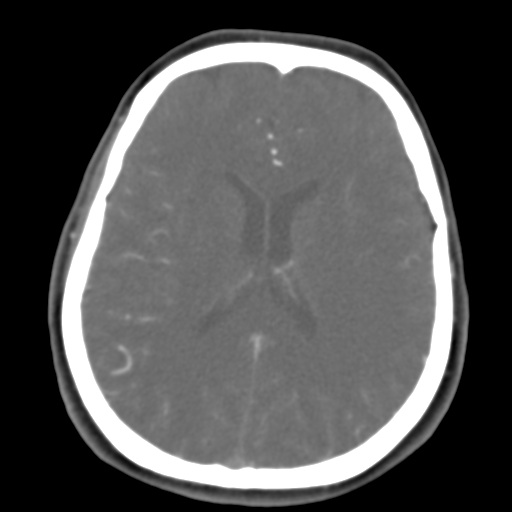 Carotico ophthalmic aneurysm (Radiopaedia 42916-46148 A 23).png