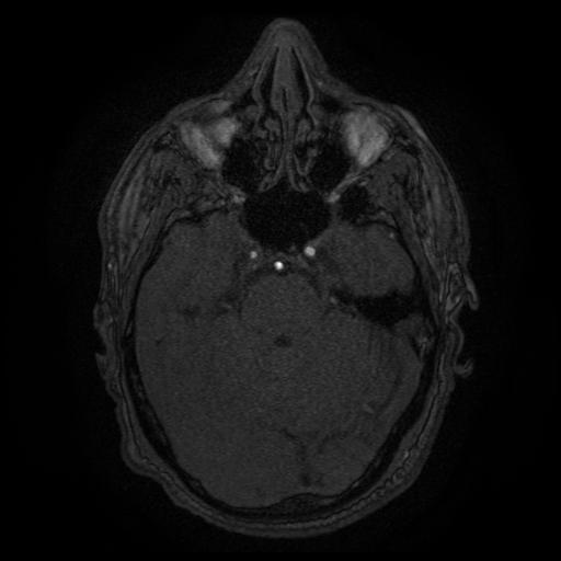 File:Carotid arterial dissection with acute cerebral infarction (Radiopaedia 26636-26784 MRA 120).jpg